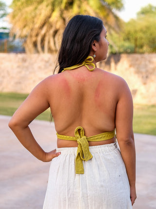 A woman stands outdoors with her back to the camera, revealing noticeable red sunburn marks on her upper back and shoulders while wearing a yellow Titania Crop Top and a white skirt.